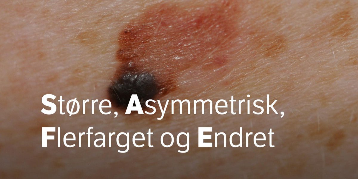 .@Kreftforeningen sin nye huskeregel SAFE skal hjelpe nordmenn med å oppdage farlige forandringer i huden tidligere. nrk.no/livsstil/na-sk…