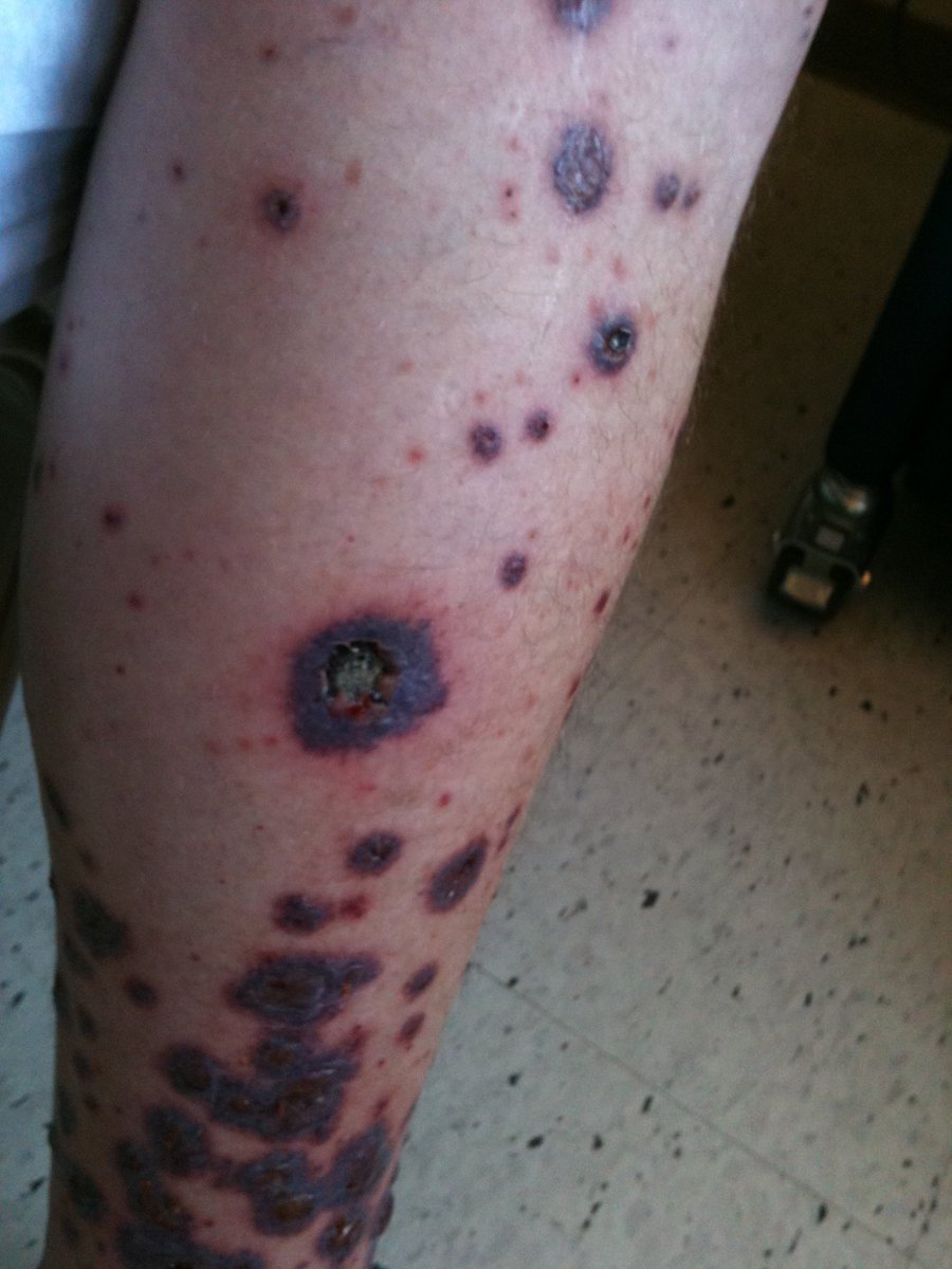 LMSWriting's tweet image. He woke up one day in pain - lost job, healthcare, and dignity! Took 5 years to get Medicaid - don't take it away @SenateGOP