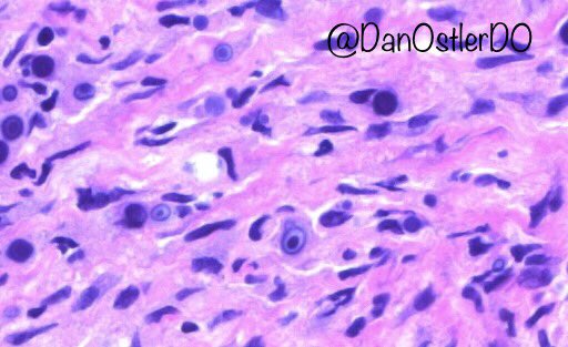 DanOstlerDO's tweet photo. anal canal "mass" - foamy histiocytes, concentrically layered basophilic cytoplasmic concretions. #malakoplakia #michaelis-Gutmann bodies https://t.co/bGvK1gyIYm