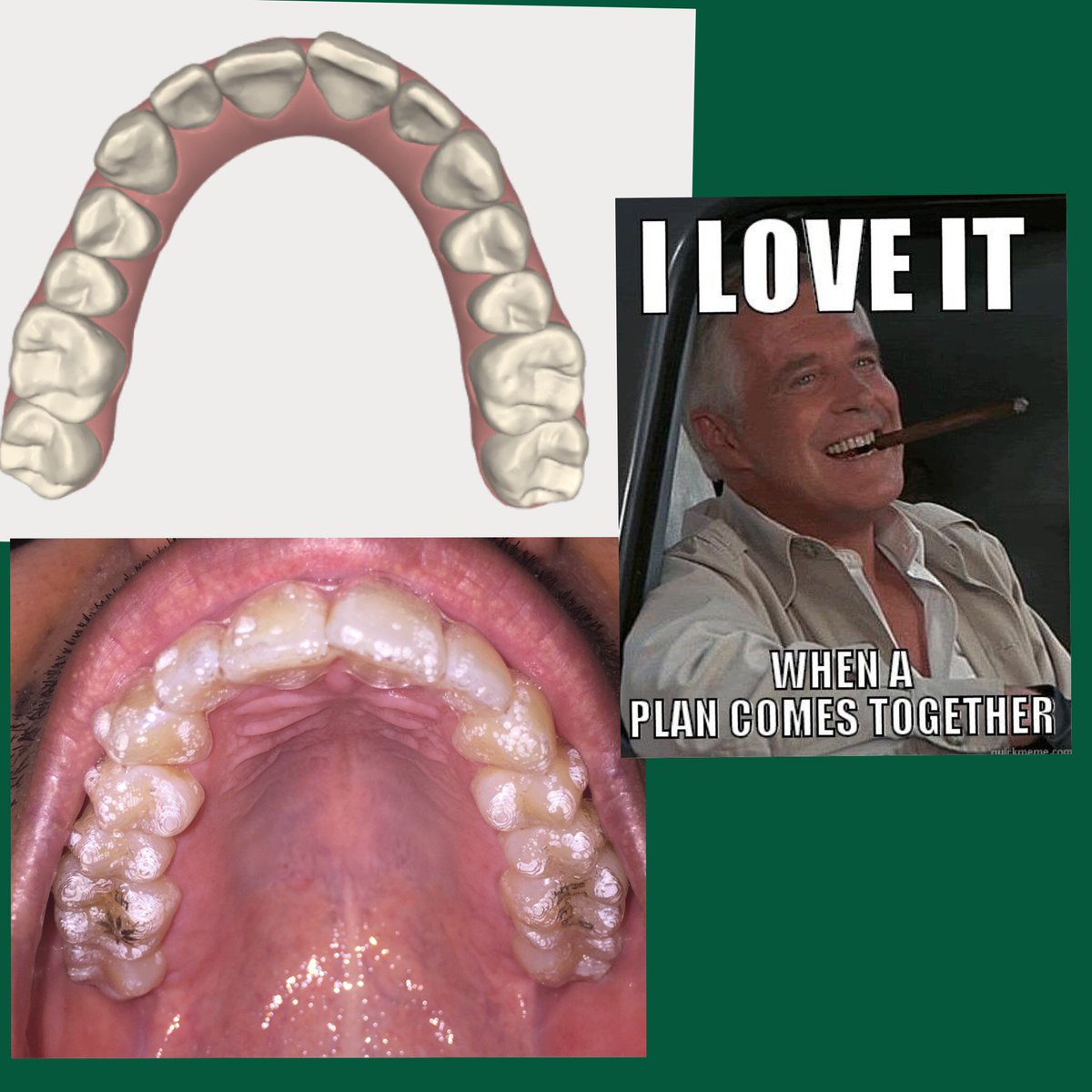 Trays fitting well, everything where it's supposed to be. What say you, Hannibal? #Invisalign #redondobeach #ateam