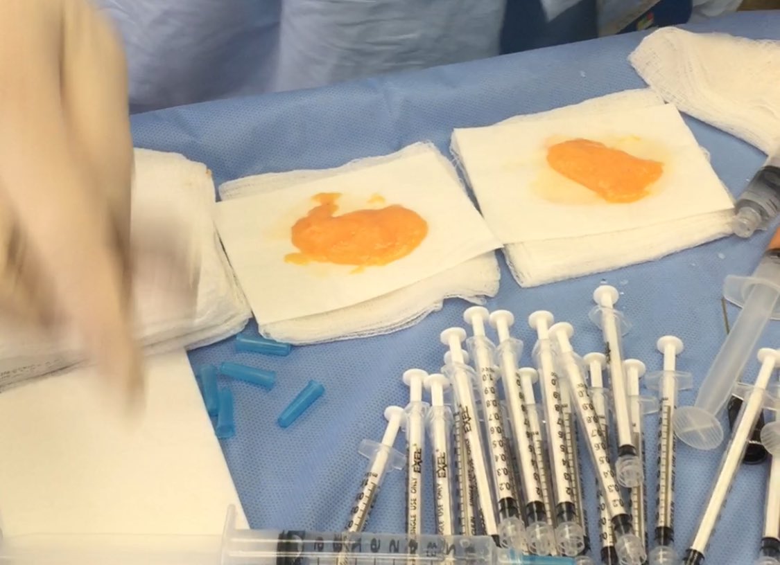 DavidSantosMD's tweet image. Best practices for facial #fattransfer @CSTNow #VCS2017  …smeticsurgerytimes.modernmedicine.com/cosmetic-surge…