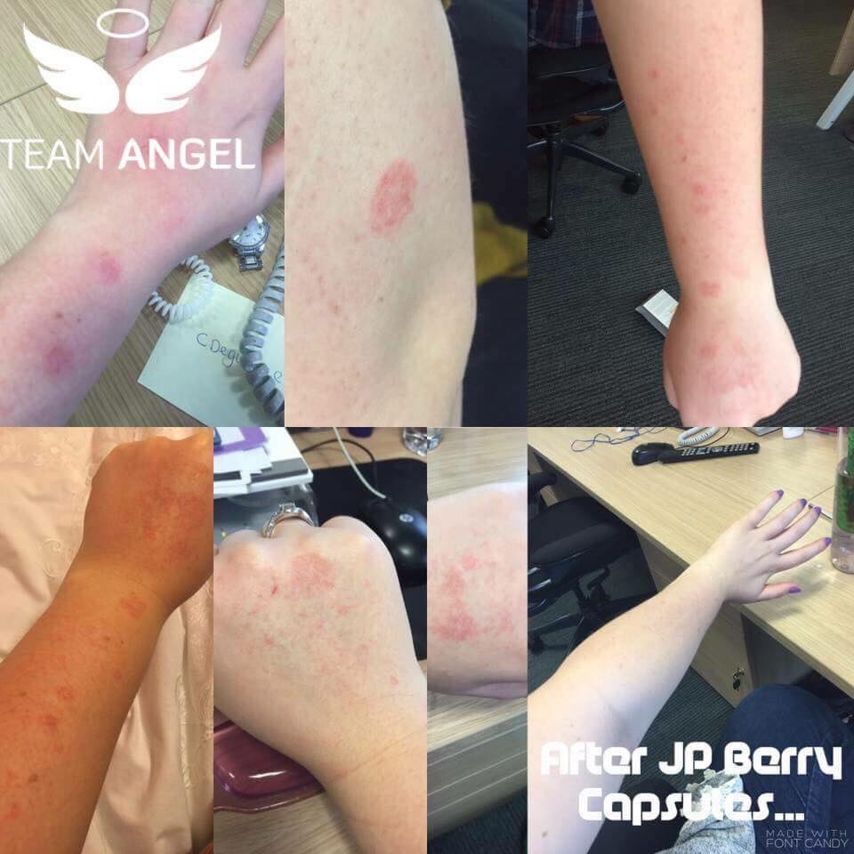 CatherineHack1's tweet photo. I can totally relate to Laura's condition,look at her results!🍇😱
"Psoriasis results,8weeks on berry capsules&amp;it's never returned"
#psoriasis https://t.co/0kyPo1DbBN