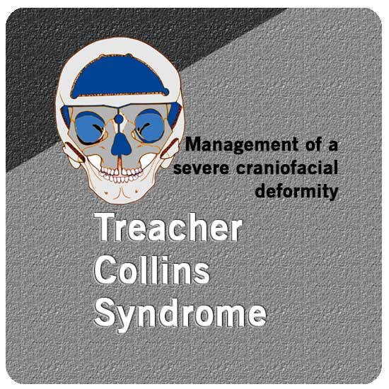 AndeiSoI's tweet photo. Comprehensive treatment for this patient with #Franceschetti #Syndrome with #calvarial and #iliac bone grafting.
https://t.co/2dIMCp3Dlu https://t.co/EXpfYQcmmd