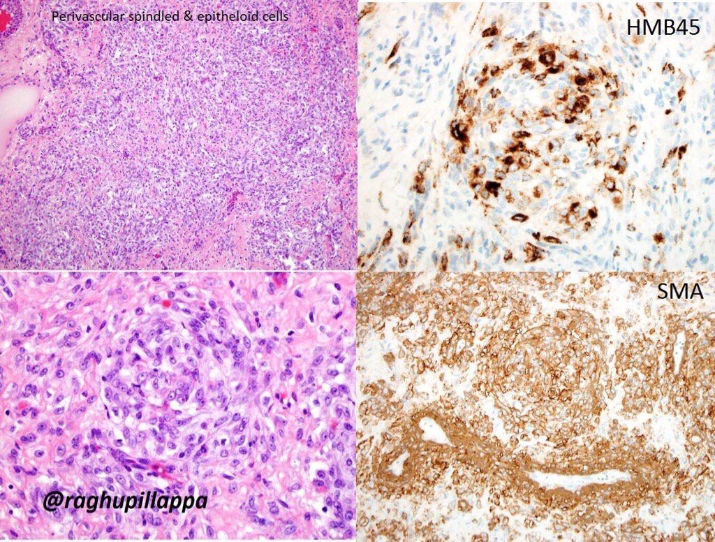 JMGardnerMD's tweet photo. Uterine PEComa. Myoid (SMA and/or desmin) &amp; melanocytic (HMB-45 and/or MART-1) markers +. S100 usually neg. pics: @raghupillappa #pathology https://t.co/UGK8leRbWm