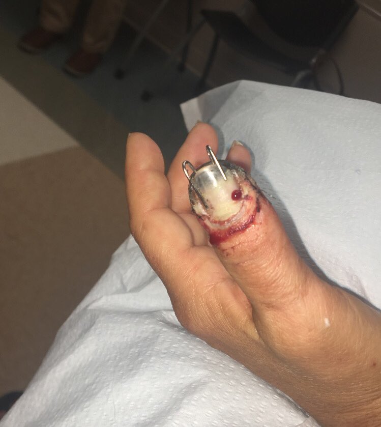emilyseitzinger's tweet photo. When you and your mom both have nail injuries at the lake😩😭🏥😩🤕 RT if you think mine is worse💉💉 https://t.co/NR77u93G4M
