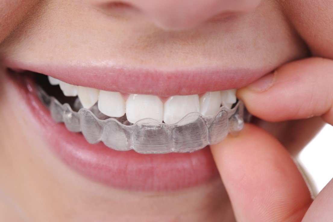 BluebellClinic's tweet photo. #Invisalign treatment is the best solution for your #teeth straightening. Don’t miss our #Invisalignoffer with £600 discount,until June 25th https://t.co/joxRvTI89n