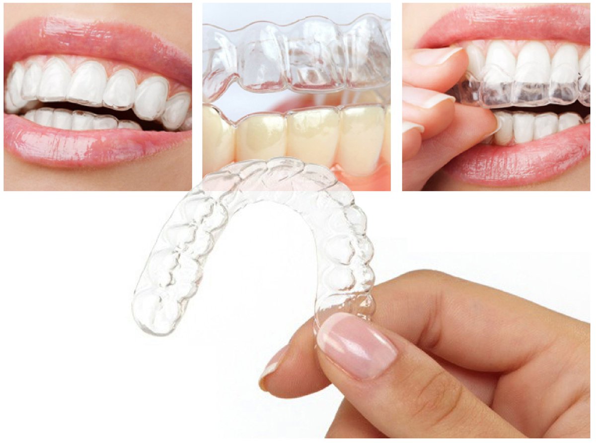 Durban_Dental's tweet photo. #Smilelign Invisible #Braces can be used for the majority of misaligned or poorly spaced #teeth problems including #overbites and #openbites https://t.co/NPwg2KiWMX
