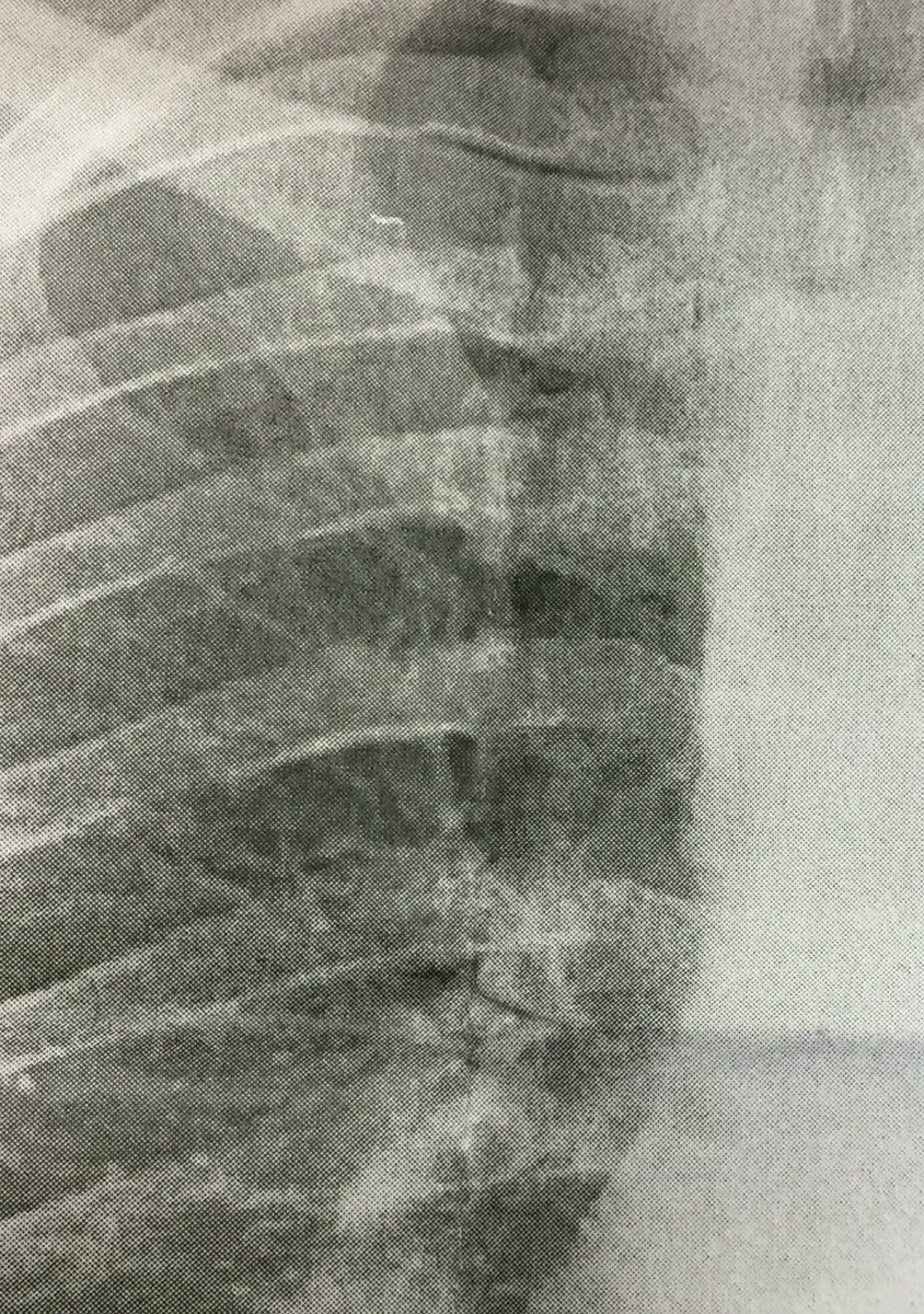 IAPMacca_D's tweet photo. 1 week off due to 4 Broken Ribs, what was a trip to the Docs for ? Chest Infection ended up with an A and E visit and this surprising #xray https://t.co/woKz1HCvIZ