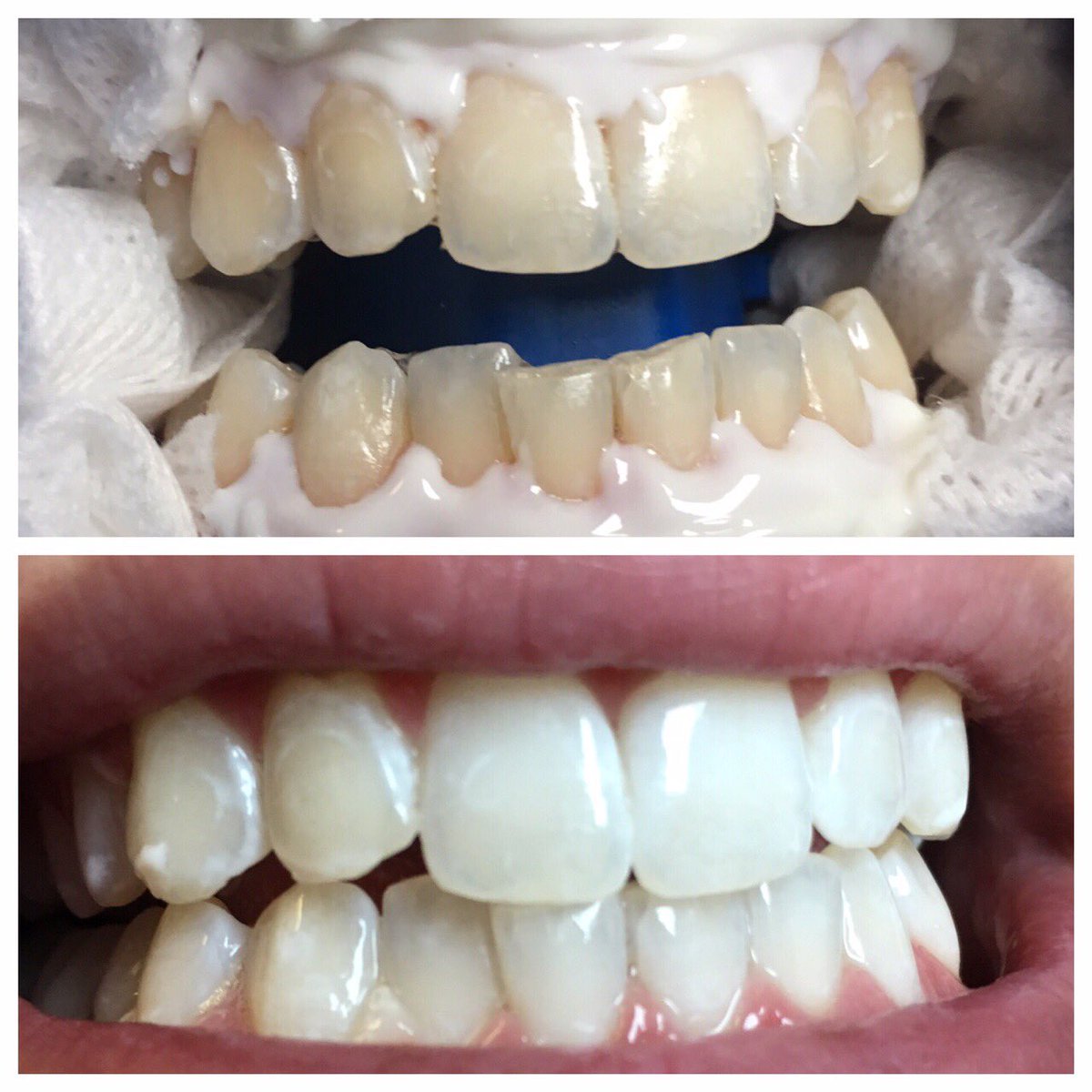 Check out Chris' amazing Zoom teeth whitening results! Call us to schedule your Zoom treatment Sale$250 ($650 value)