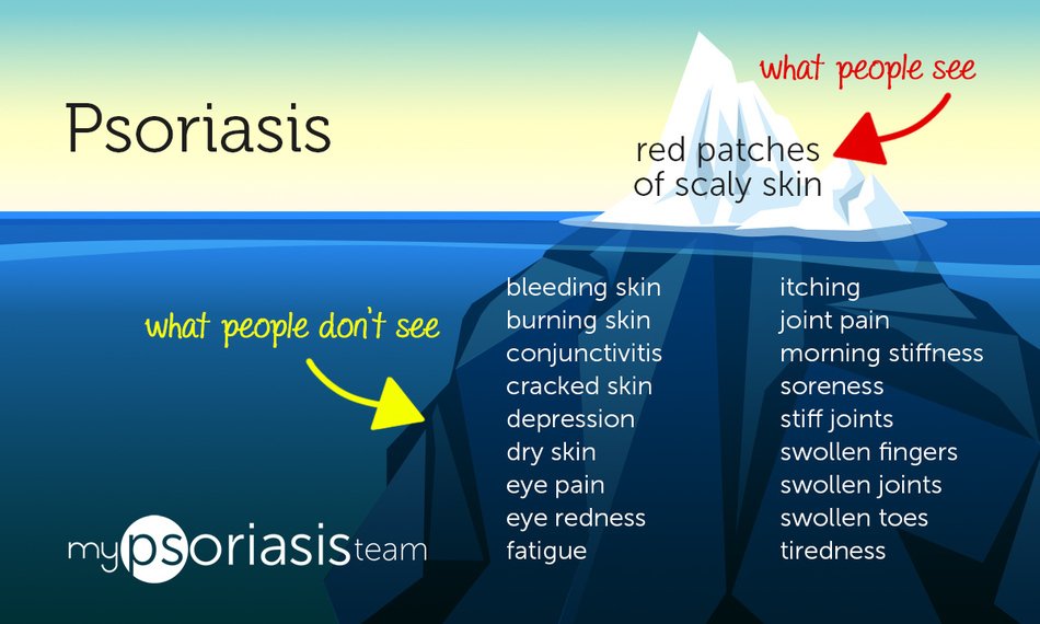 MyPsoriasisTeam's tweet image. The iceberg is perfect for explaining what #Psoriasis is really like to friends and family: ow.ly/ol5f30by3Zb #PsoriaticArthritis