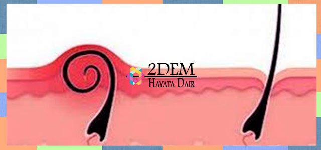 Kıl Dönmesi Neden Olur? Kıl ... ve #KılDönmesiNasılAnlaşılır #KılDönmesiNasılGeçer tüm bilgiler için tıklayınız 2dem.com/2017/06/kil-do…