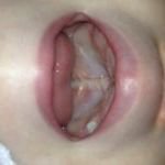CLAPACOMMUNITY's tweet photo. A cleft lip is repaired within a baby's 1st 3-6 months. A cleft palate is repaired within 6-12 months https://t.co/G5CGypGNiQ https://t.co/G1ODnqCe94