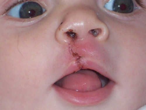 CLAPACOMMUNITY's tweet photo. A cleft lip is repaired within a baby's 1st 3-6 months. A cleft palate is repaired within 6-12 months https://t.co/G5CGypGNiQ https://t.co/G1ODnqCe94