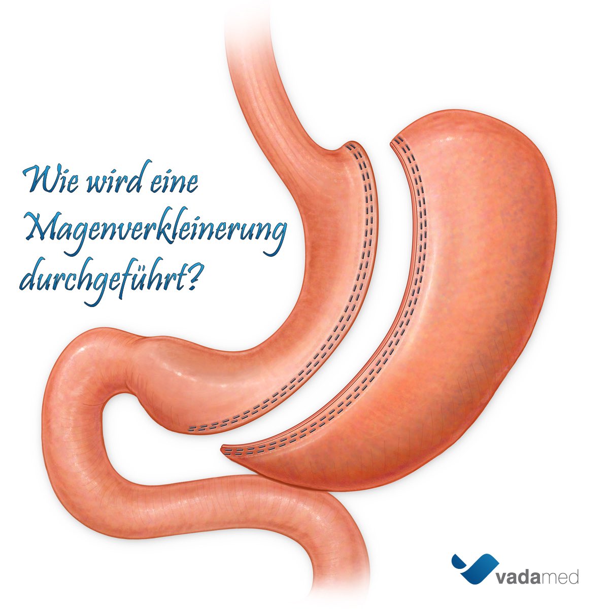 SleeveGastrectomy: instagram.com/p/BVRzLfYgjxF/
#sleevegastrectomy #schlauchmagen #bariatric #bariatrischechirurgie #obesity #weightloss #vadamed