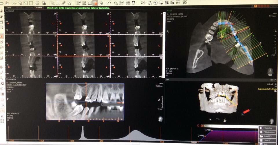 ISBucodental's tweet photo. Tecnología de vanguardia en #ISBucodental  Escáner 3D https://t.co/LGaUuIjfyZ