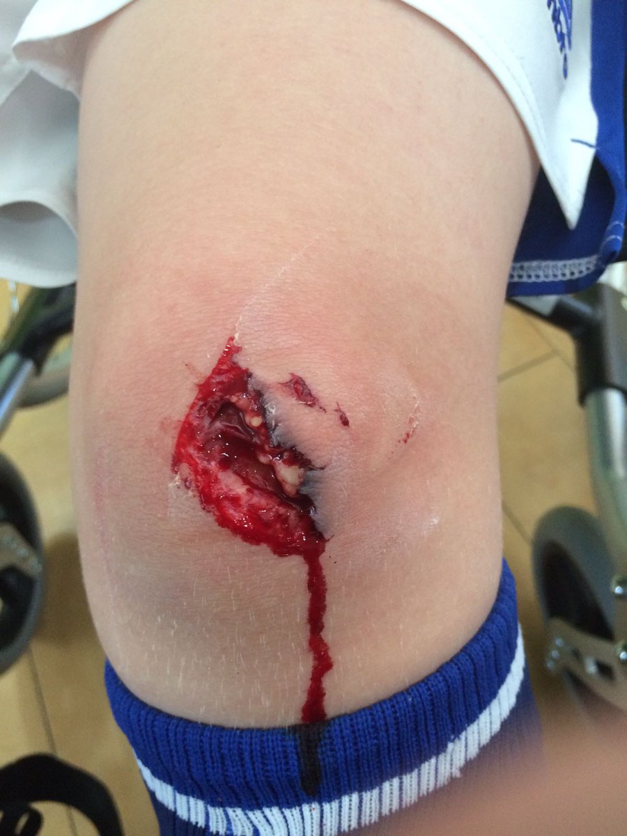 ASViking's tweet photo. Nice little scratch for Charlie. Blood on the new @Everton socks. #prayforcharlie @XxLippicious #6stitches https://t.co/u11m43j9i2