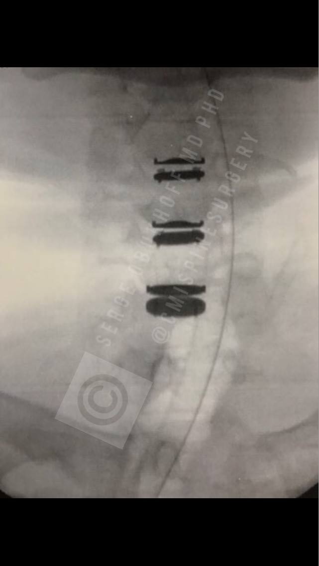 cmispinesurgery's tweet photo. #Complex #multilevel #totaldiskreplacement #tdr #artificialdiskreplacement #adr procedure performed at #cmispinesurgery by #DrObukhoff https://t.co/hpJC2HOUYk