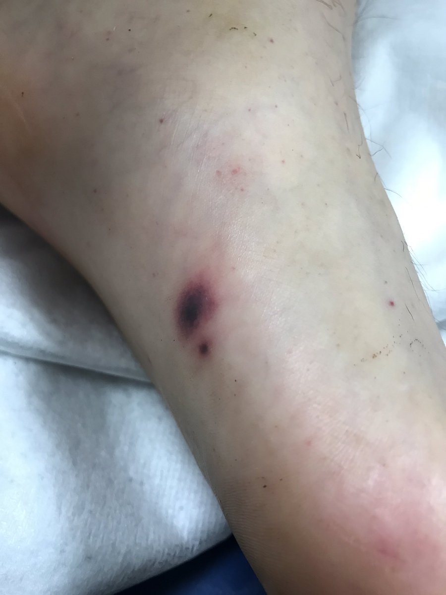 60SecMedEd's tweet photo. Foot of an altered, intravenous drug user.... https://t.co/7FmFVlC0Jk