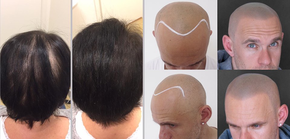 Follica On Twitter Hair Tattoo Gilbert Az 85296 Scalptattoos