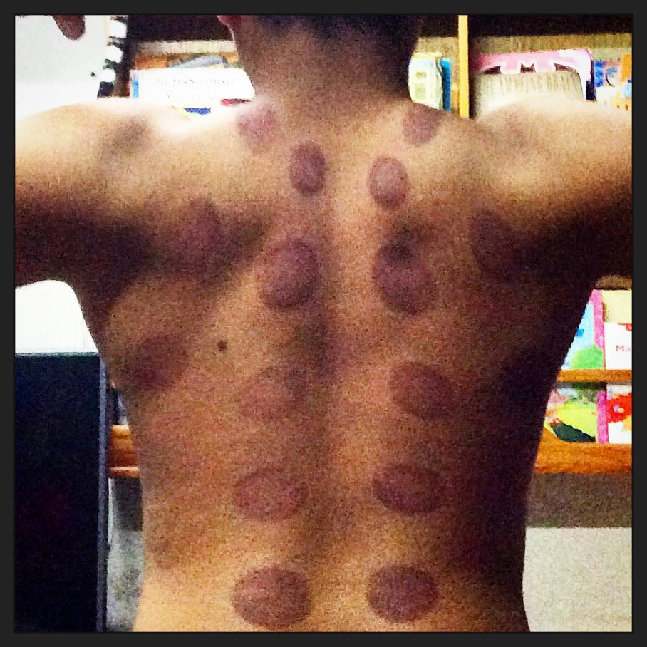 wynni28tonichi's tweet photo. I have my own #YayoiKusama installation! 😜🤘🏼 #DottyAboutDots #CuppingSession #VentosaTherapy @potato167 😙❤️ https://t.co/J6l61rEerF