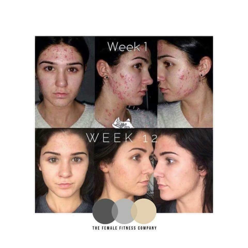 beckiik1984's tweet photo. Wow just look at these Skin results!!! 😍😍😍😍

#skin #results #berries #capsules #vegan #hair #nails #liftednotgifted https://t.co/GWnoU2F8a7