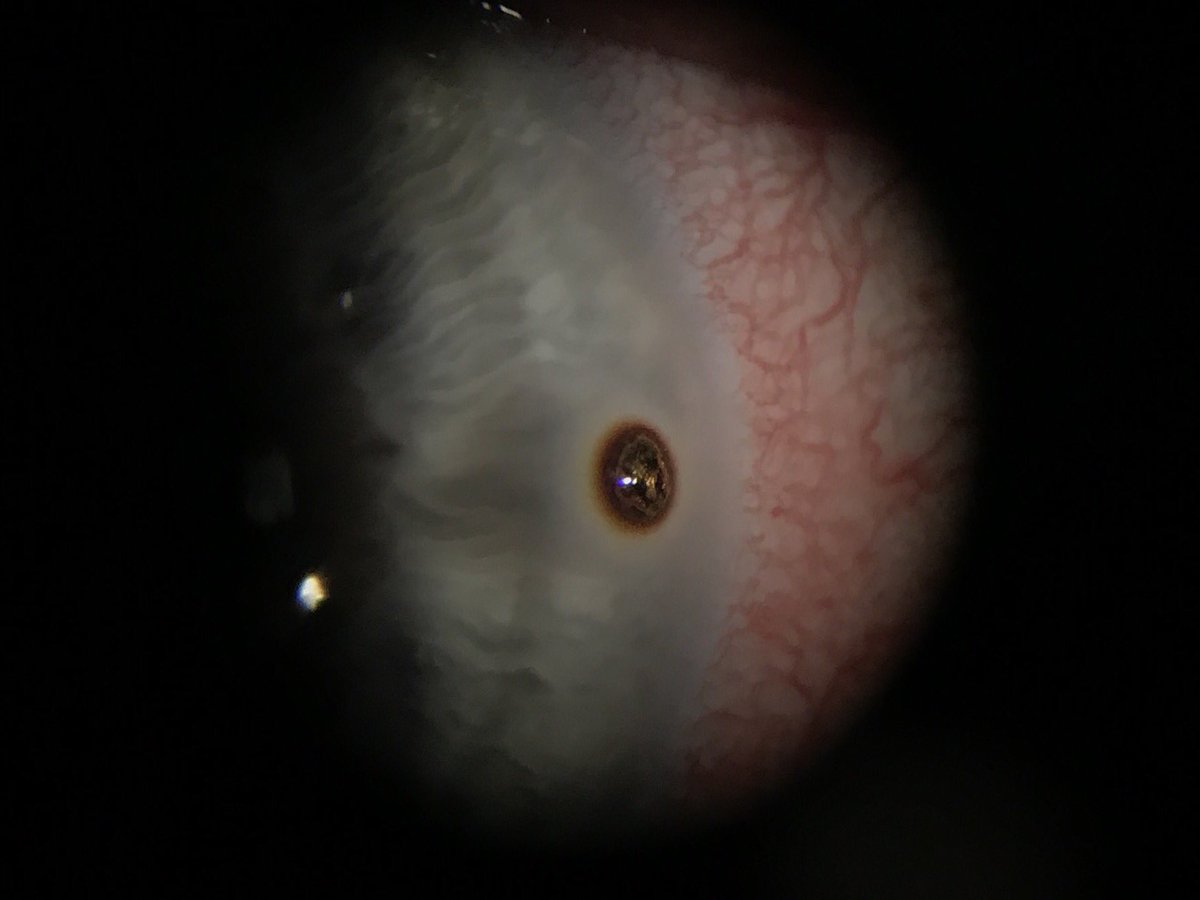 David Gould On Twitter Metallic Foreign Body With A Surrounding Rust Ring On A Cornea That We Saw Today Please Wear Eye Protection To Reduce The Risk Of Injury Https T Co T80imglyrl