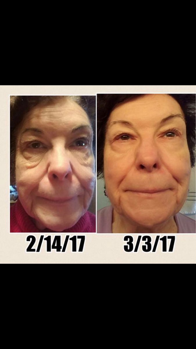 CoachHuseby's tweet photo. 🔥💪💥🥇90 days #noinjections;#nophotoshop; #LBC; #Nolasers; #globalpatents https://t.co/8SNCnH3oC4