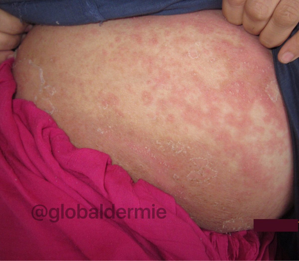 pustular psoriasis pregnancy)