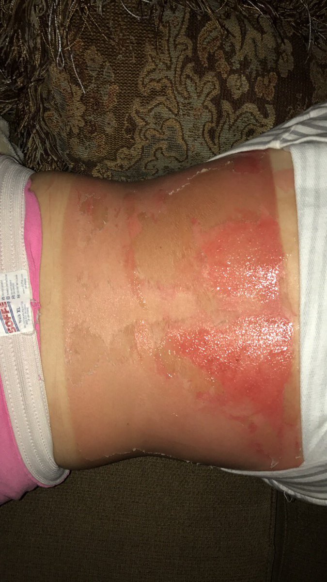 balon_molly's tweet photo. Kids please wear sunscreen. Even when it's cloudy you still get burnt. #lessonoftheday #sunscreeniskey https://t.co/62HwAFZlv3