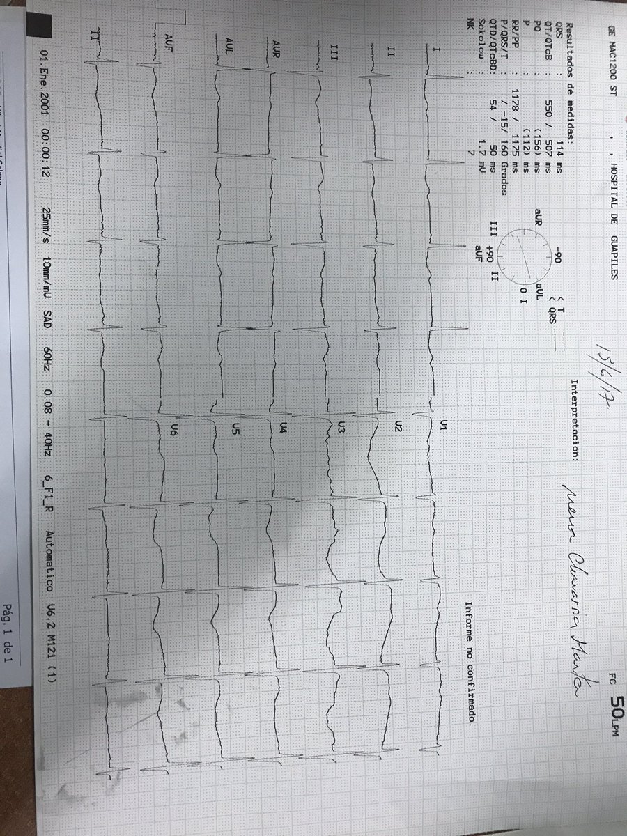 earias316's tweet photo. @crisrodriguez73 Fem 75a, EPOC (SBT) DMII (30-30-30 NPH), epigastralgia de 1 semana, ingresa hipoperfundida PA: 80/32 FC: 43 x' https://t.co/gtdUuC5spV