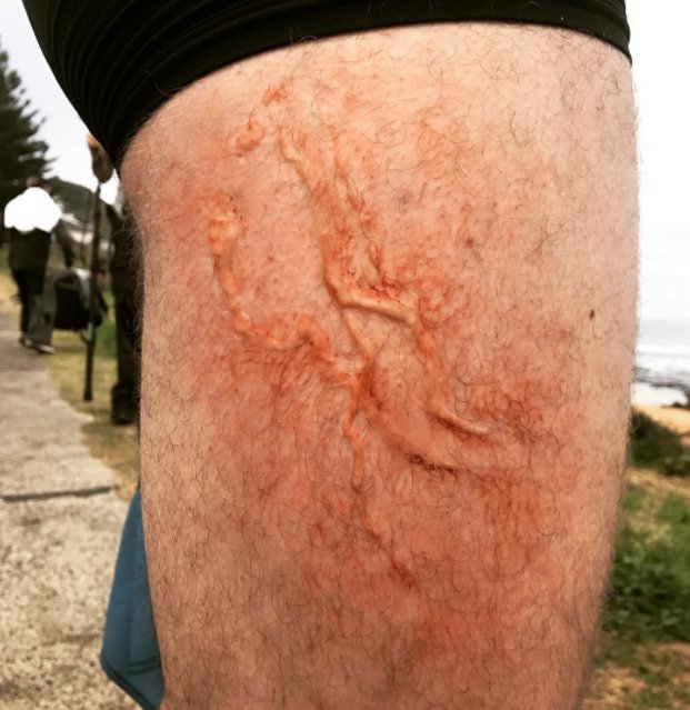 PrincipalityFX's tweet photo. Lucy Woolfman using our on-skin silicone to create a jelly fish sting look! 
#jellyfishsting #principalityfx #spx #onskinsilicone #silicone https://t.co/dbwRLCRtyj