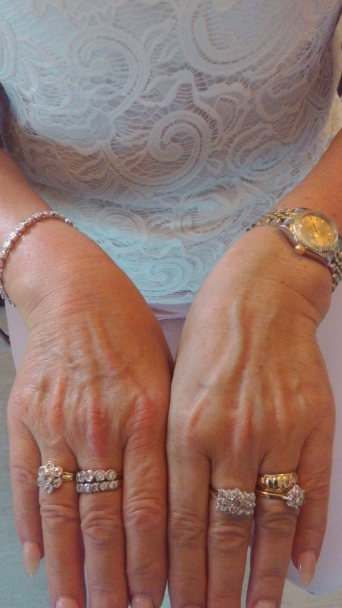 #GeneO treatment on one #hand -can you spot which one? Course you can, her left hand is visibly smoother #superfacial #lancaster #Carnforth