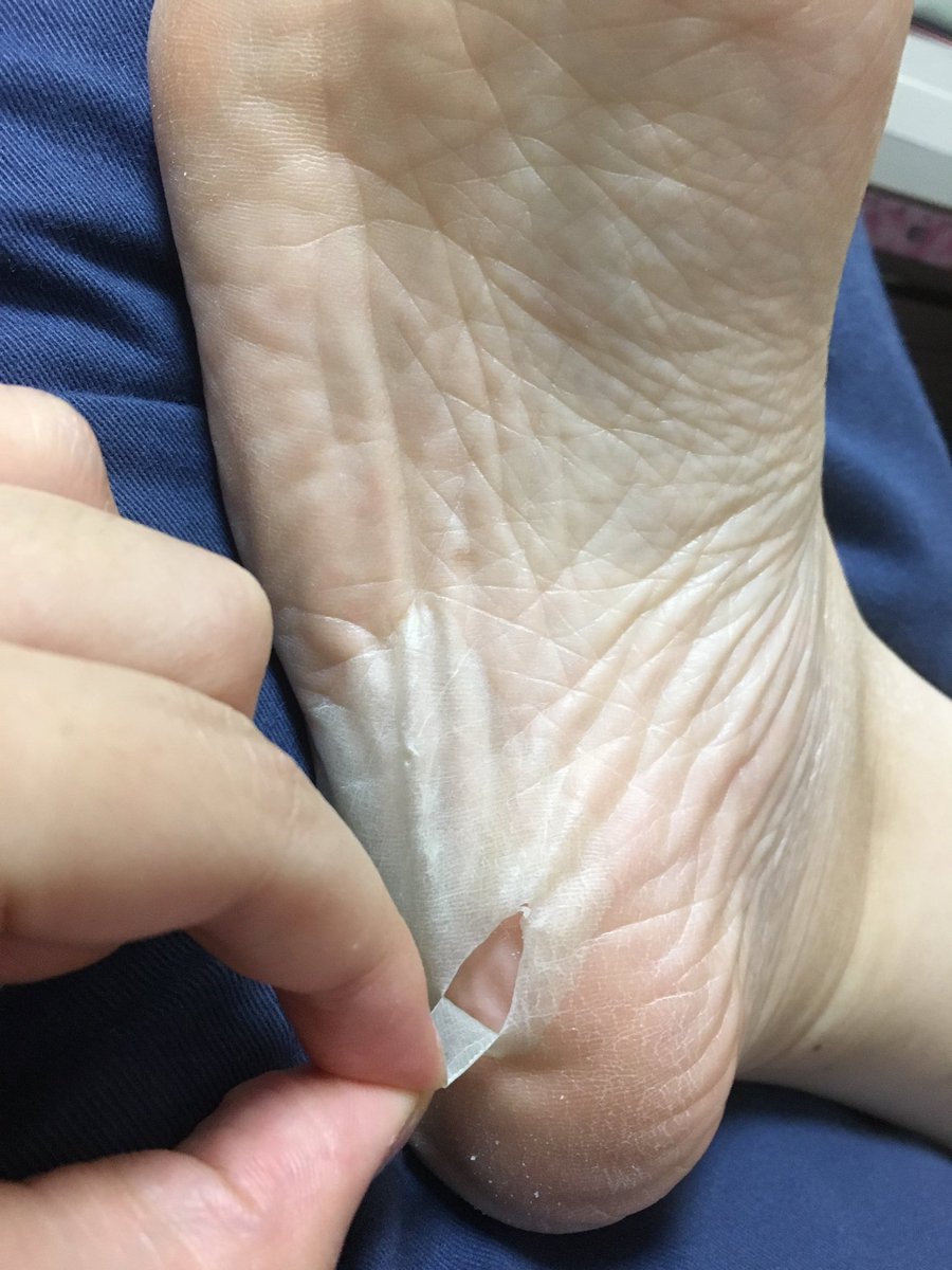 黄桜 くらげ写真が尽きたからさくらんぼで 2枚目の手前と4枚目は甲の皮 薄くて白い 2枚目奥側と三枚目は裏の皮 黄色くて厚い 結果は以上です 足裏めっちゃふわふわになりました 足裏に悩みある人はやってみるといいかも T Co