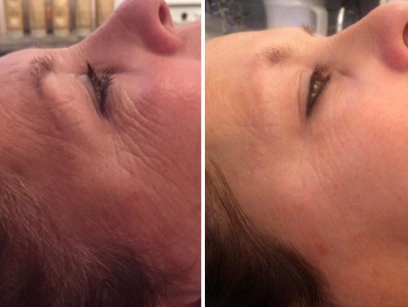NouveauALift's tweet photo. Look at these amazing results from FIVE A-Lift treatments! 
#alift #healthyskin https://t.co/W2u2lUwBnW