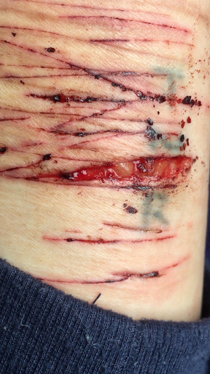 脂肪たくさん出てきてた