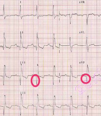 Eğer Q dalgasının boyu R dalgasının boyunun 4/1 den fazlaysa Patolojik Q dalgası denir ve miyorkard nekrozunu gösterir.
EKG:Eski Inferior MI