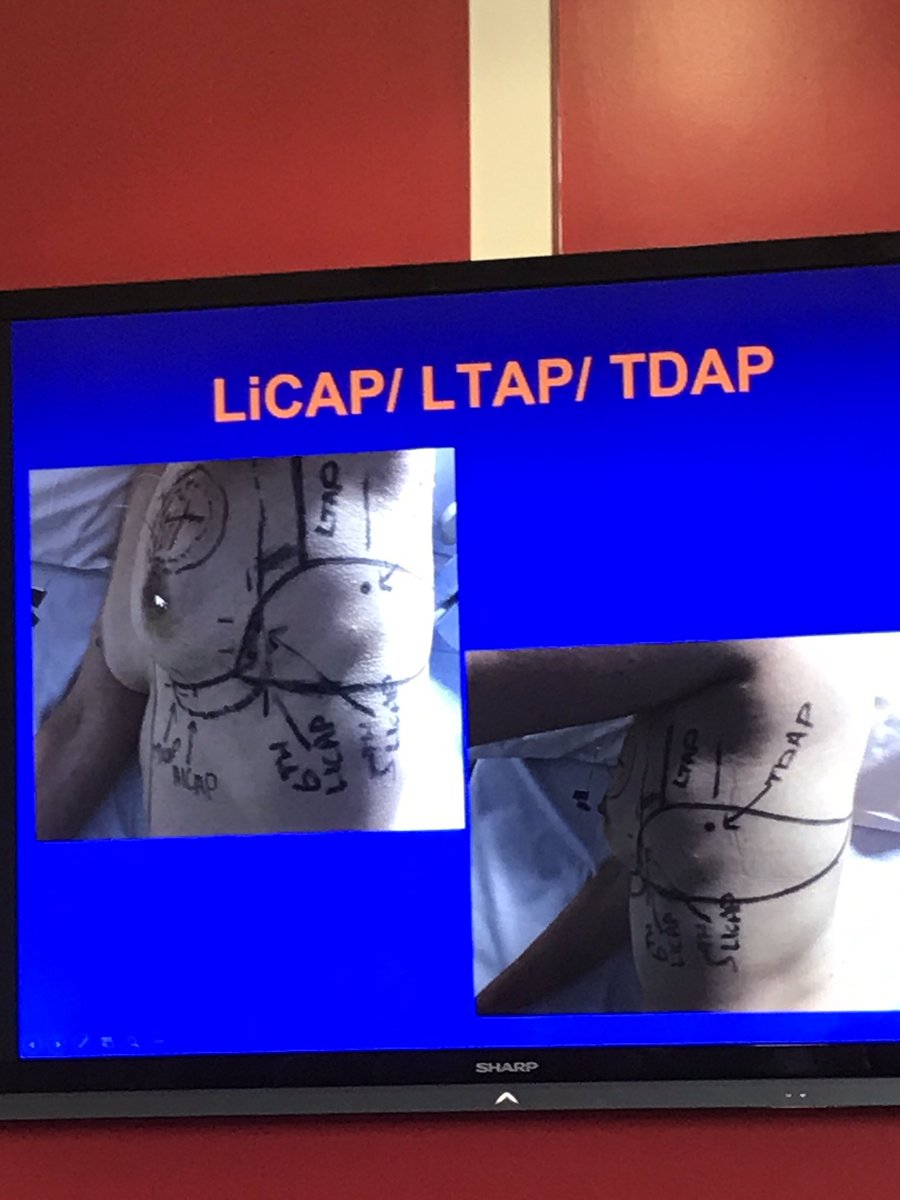 askanushka's tweet photo. #perforatorflaps may be a good option in smokers for #breastreconstruction and avoid #adm #breastimplants @ABSGBI @KeeleUniversity https://t.co/tGSNSK89Sd