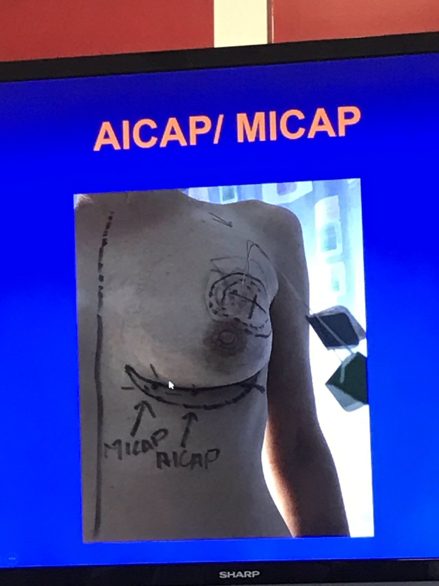askanushka's tweet photo. #perforatorflaps may be a good option in smokers for #breastreconstruction and avoid #adm #breastimplants @ABSGBI @KeeleUniversity https://t.co/tGSNSK89Sd
