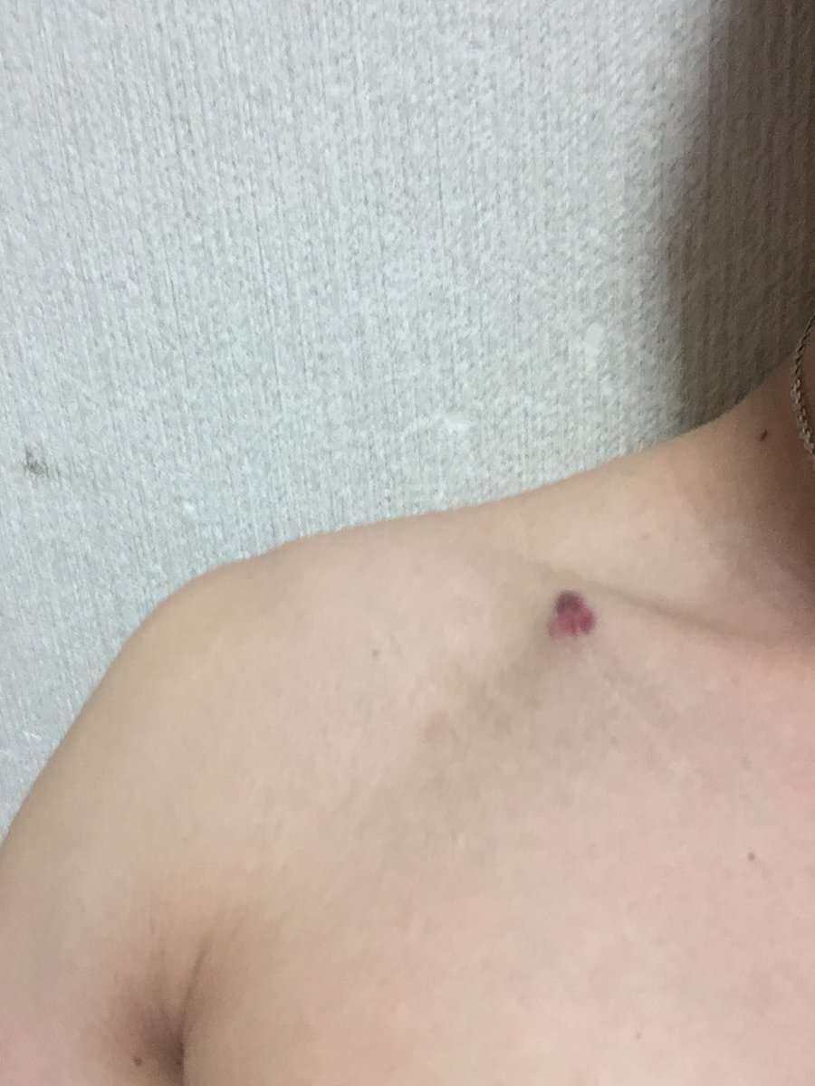 Twitter पर ヘイヘイボーイ 風呂入って鏡を見ると笑ってしもた 鎖骨付近の所内出血してる 笑 キス魔付けられた後みたい 笑 誰に襲われたんやろ爆笑