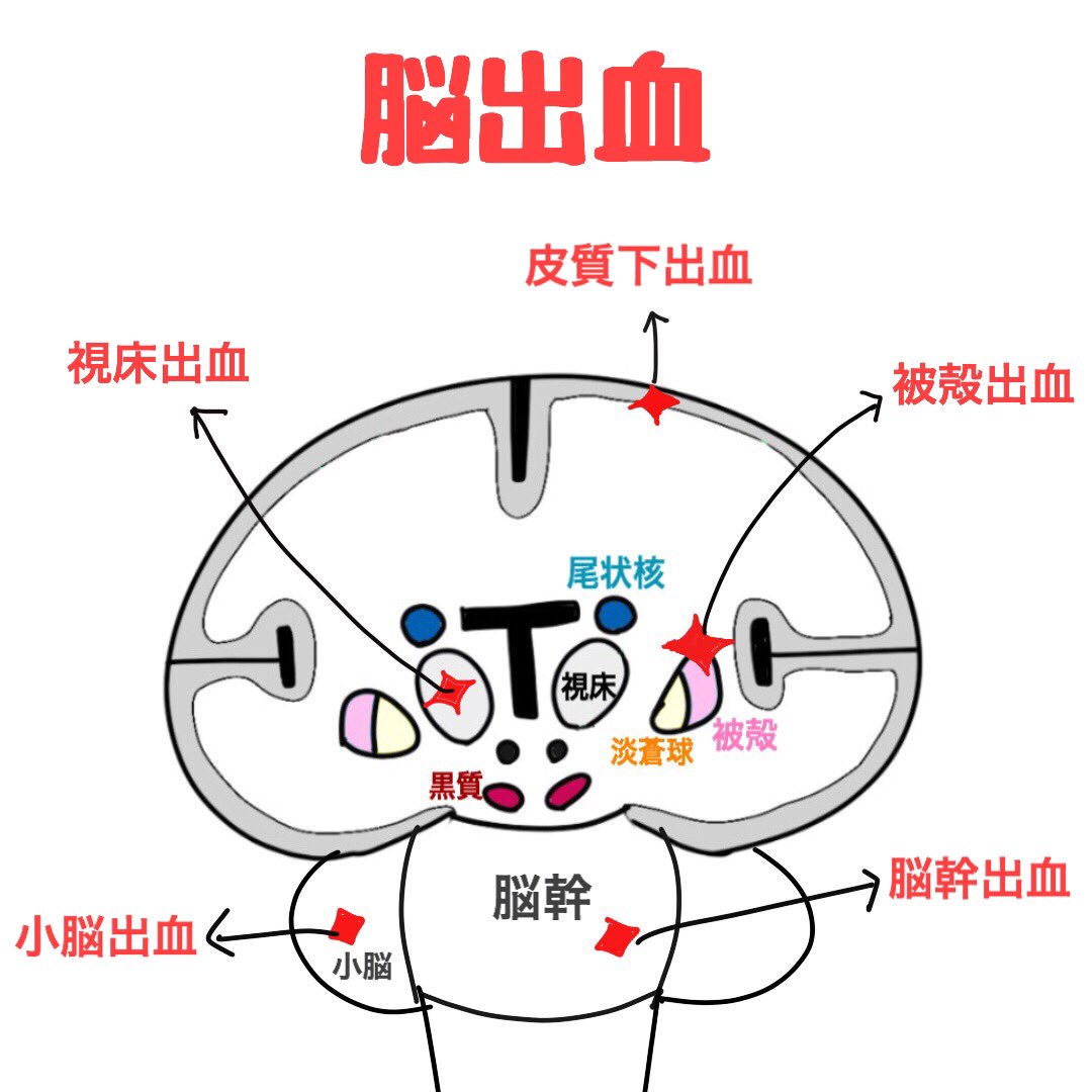 ゴロ 解剖生理イラスト 脳出血が起こりやすい場所まとめ 1位 被殻出血 2位 視床出血 この2つだけでも覚えておくべし