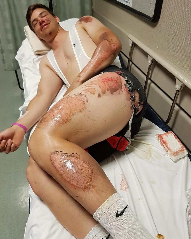 Took a nasty spill training a few days ago. Thankful it is just road rash! #shredded #onthemend