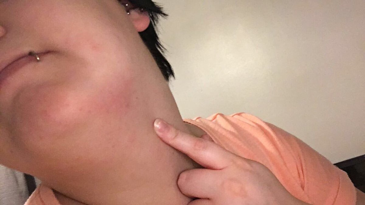 redundqnt's tweet photo. i can't stop scratching my face and neck so now i look like this https://t.co/GoJyUcFqYy