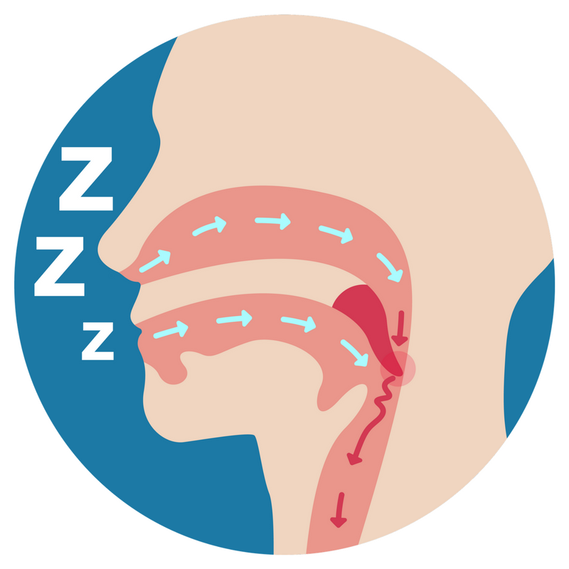 SnoreFIX's tweet photo. Are you a victim of your partner snoring?
Let SnoreFIX™ save your sleep!
https://t.co/Tus5ayEKAj https://t.co/HudoTMM3OU