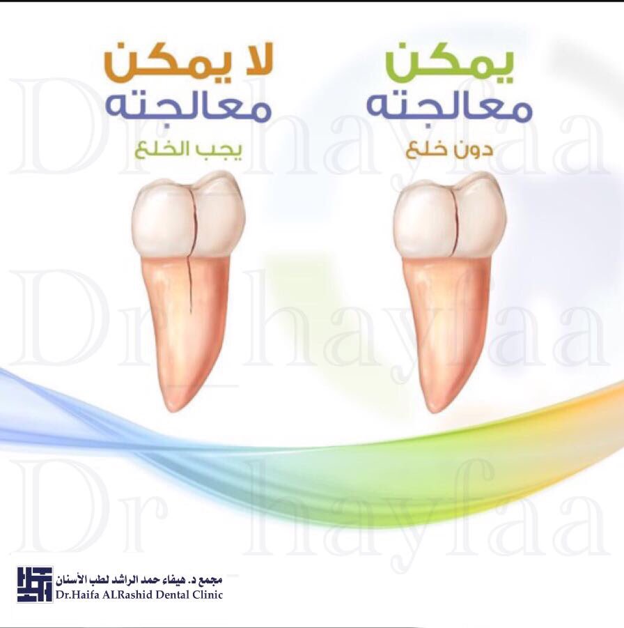 Dr_Hayfaa's tweet photo. متى يمكن معالجة "الشرخ" في الأسنان؟! https://t.co/l06bQs5dMi