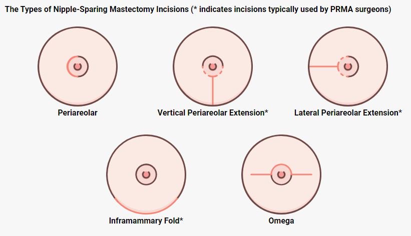 DiepFlapBreast's tweet photo. What is nipple-sparing #mastectomy and are you a candidate?  https://t.co/MPbbb8jYp6  #BCPEA #breastcancer https://t.co/ENmavark5F
