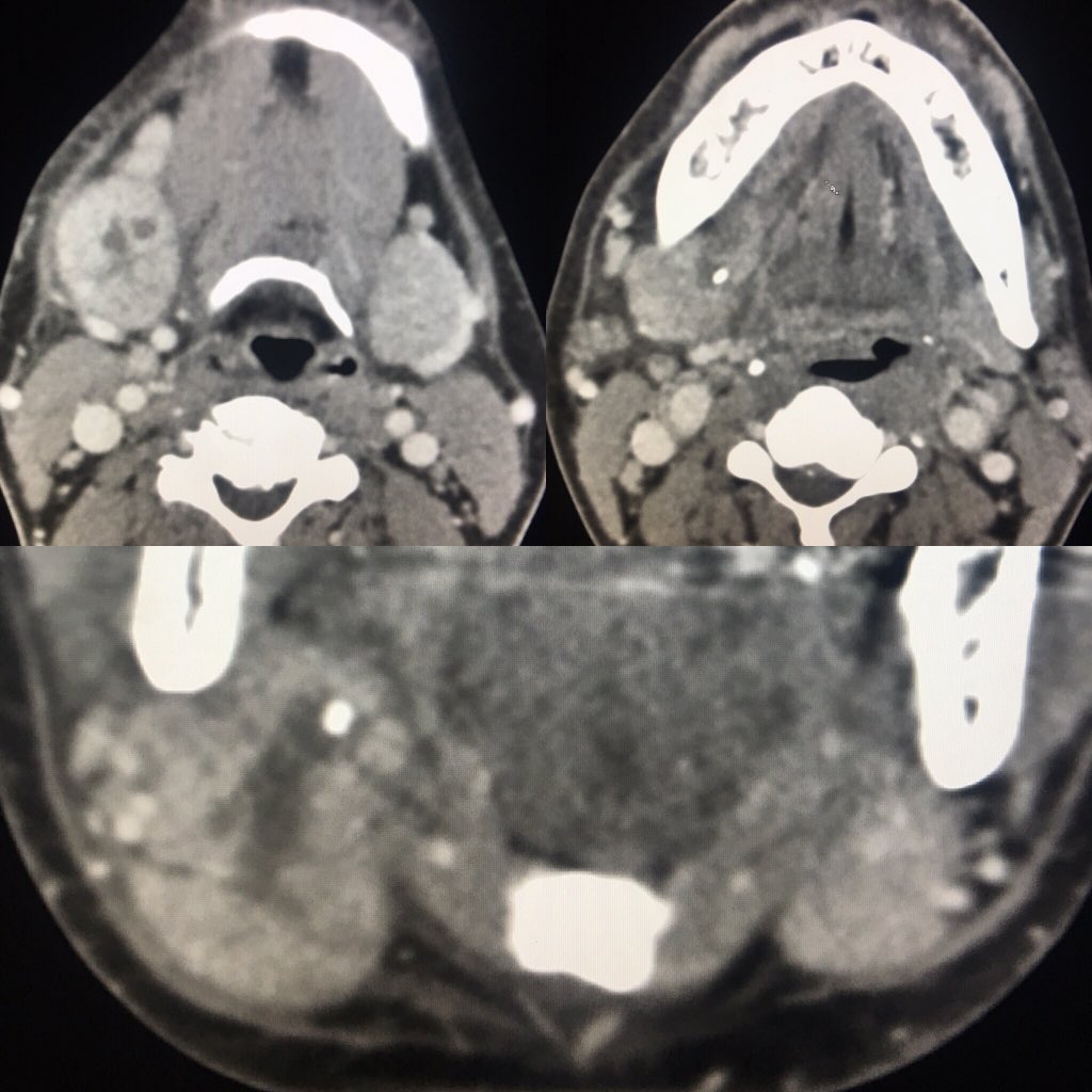 Case of the day: 52 yo w R low face pain. R submandibular sialoadenitis with visible calculus and ductal dilation