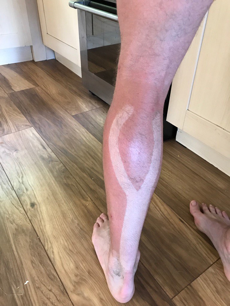 Sunburn