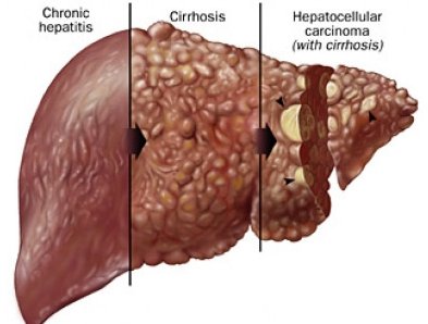 ElmTreeMedical's tweet photo. #Pregnant women w #liver #cirrhosis have 9.7% higher absolute risk of fetal anomalies https://t.co/UXMgQhmPSE #hepatology #MFM #ACOG2017 https://t.co/VNRh9C2urJ