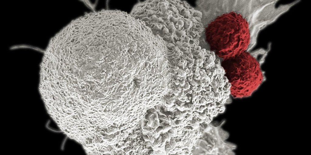 A new case sheds light on a possible autoimmune manifestation of #immunotherapy for cancer. ms.spr.ly/6018rthhG