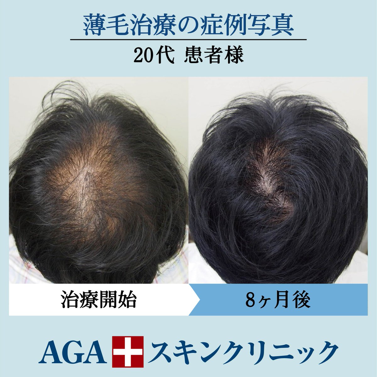 フサちゃん Agaスキンクリニック公式 Ar Twitter こんなに変わる 当院の薄毛治療 20代で薄毛に悩まされている方も多いです しかし個人差はありますが ほとんどの方が比較的早い段階で発毛を実感されます こちらの患者様も３カ月くらいから 変化を感じていました